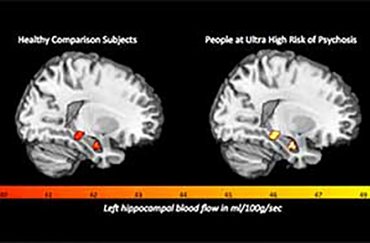 Image - Heightened blood flow in the brain linked to development of psychosis